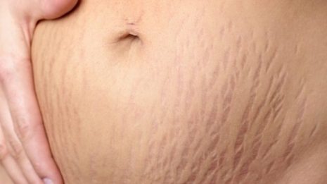 Cara Alami Menyamarkan Stretch Mark